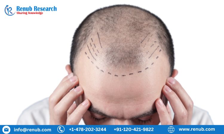Hair transplant market is projected to achieve US$ 53.17 Billion by 2028