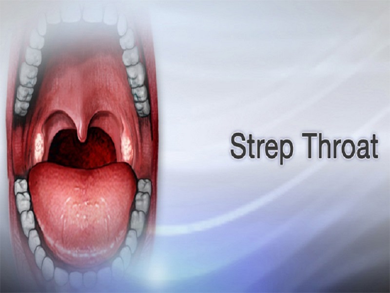 10 Steps to Get Rid of Strep Throat Without Tonsils