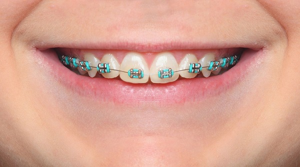 The Best Orthodontists in Miami: Where to Find Quality Care