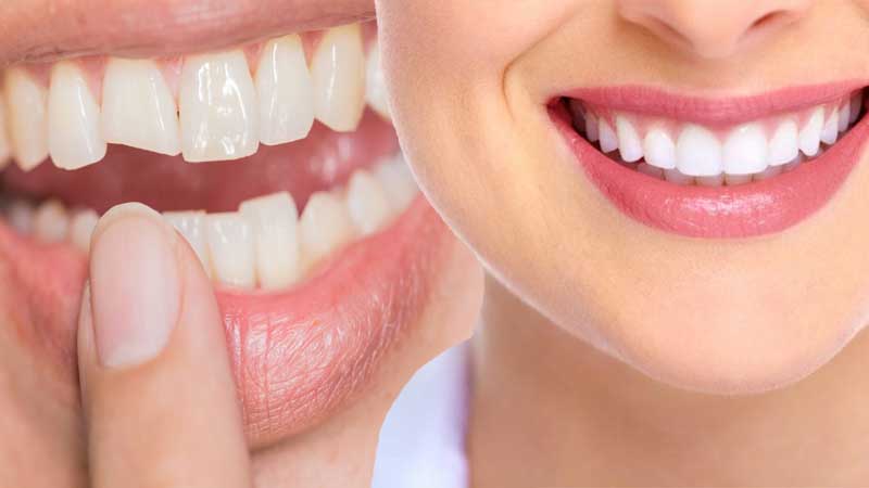 Why Should You Consider Cosmetic Dental Bonding?
