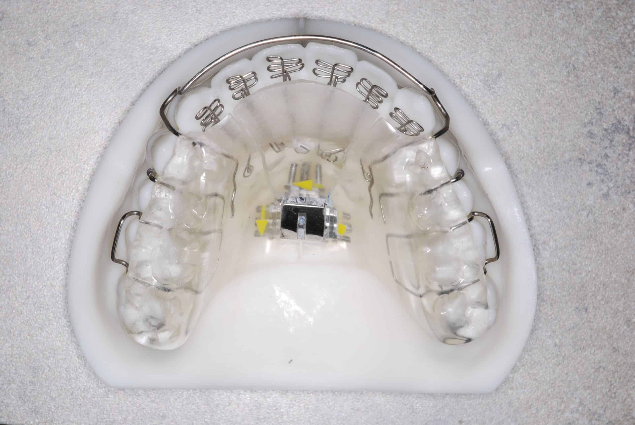 Find the Best Orthodontist Near Me for Invisalign Treatment