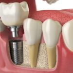 best braces colors to get