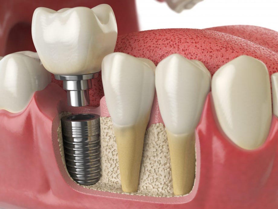 Best Braces Colors To Get: Enhancing Your Smile With Pediatric Dentist In Miami