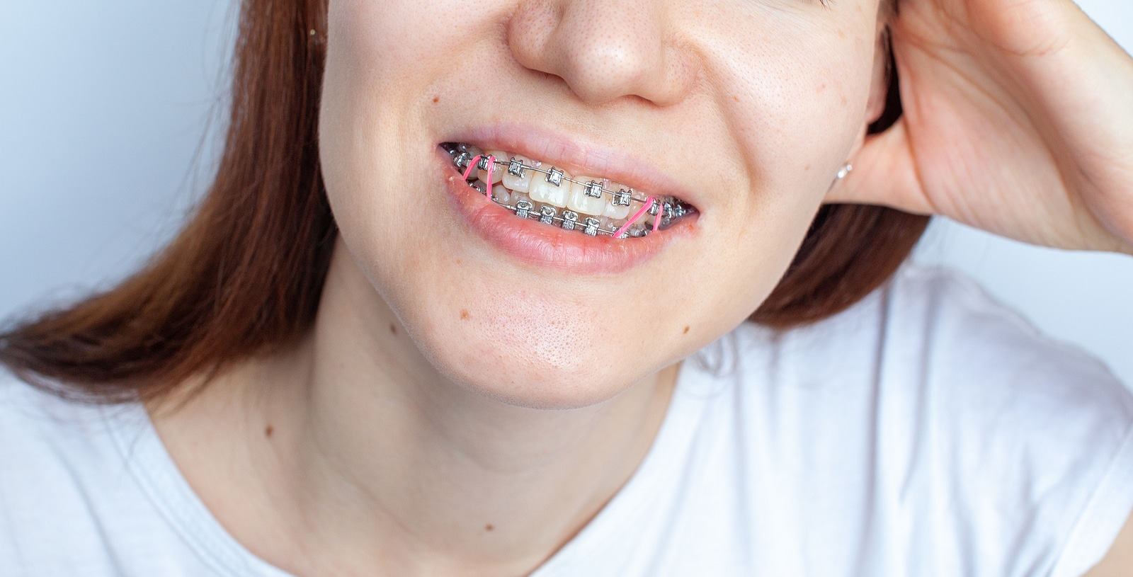 How Much Should You Expect To Pay? Best Braces Cost In Miami And Hollywood, FL.